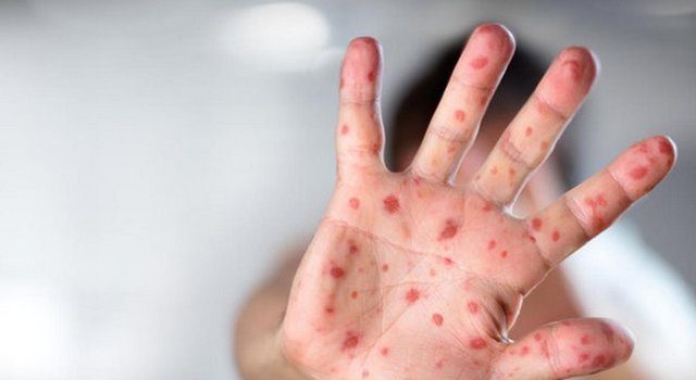 Врачи бьют тревогу из-за кори – ситуация в Ахалкалаки
